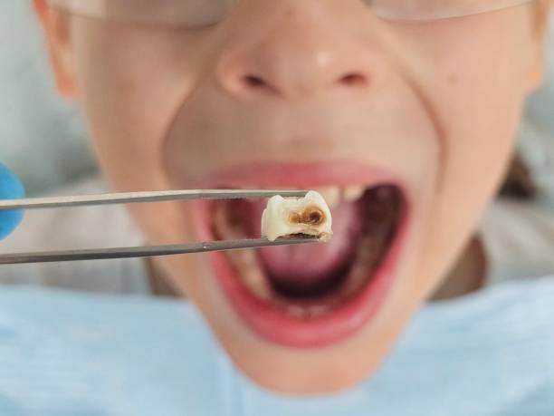 Best Emergency Tooth Extraction in Old River Winfree, TX